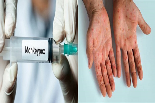 Pune Health Authorities Screen 531 Passengers from Singapore and Dubai as Mpox Risk Rises