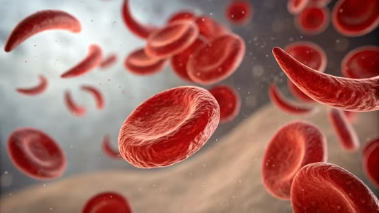 Sickle Cell
