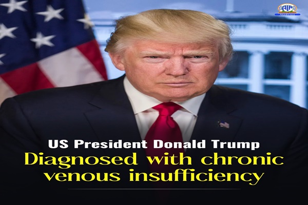US President diagnosed with chronic venous insufficiency